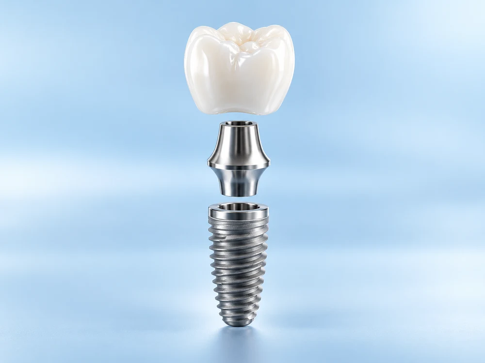 Ilustración de un implante dental con corona, pilar y tornillo separados